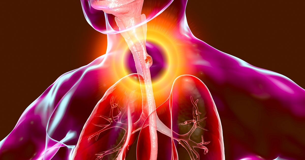 Esophageal Cancer