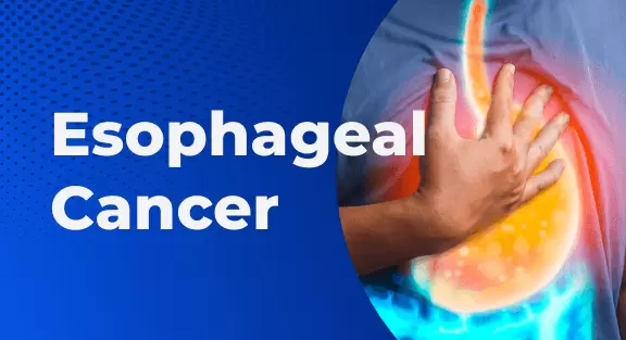 Esophageal Cancer