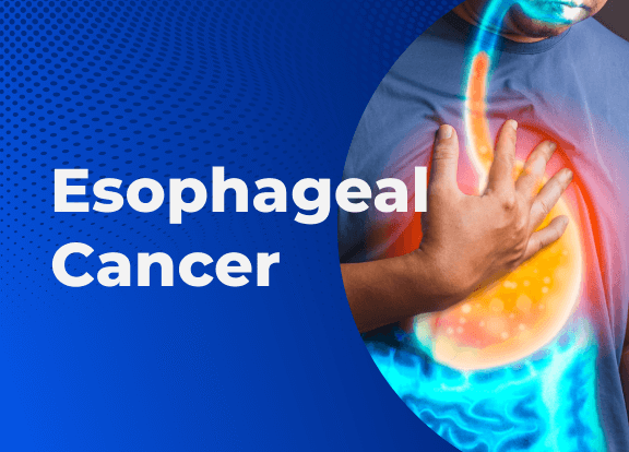 Esophageal Cancer Esophageal Cancer
