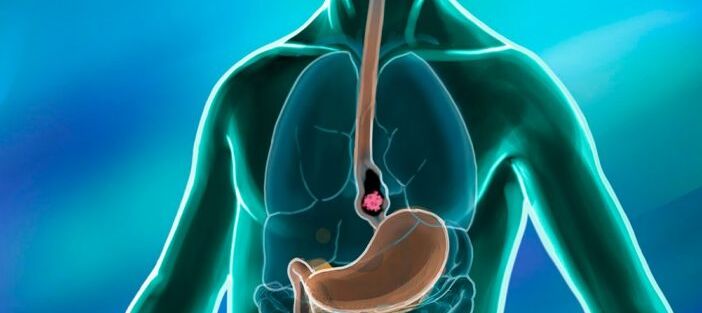 Esophageal Cancer