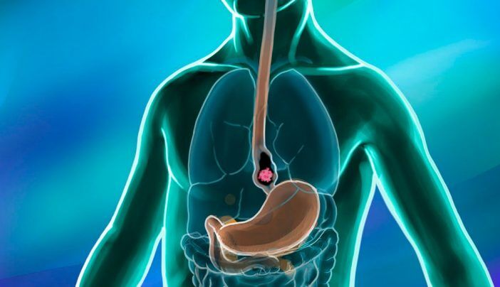 Esophageal Cancer